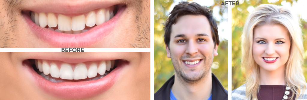 Smile_Brilliant_Before_After